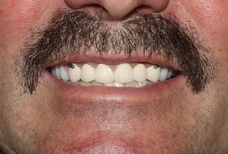 Комплексное восстановление зубов