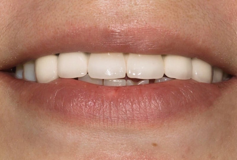 Имплантация передних центральных зубов