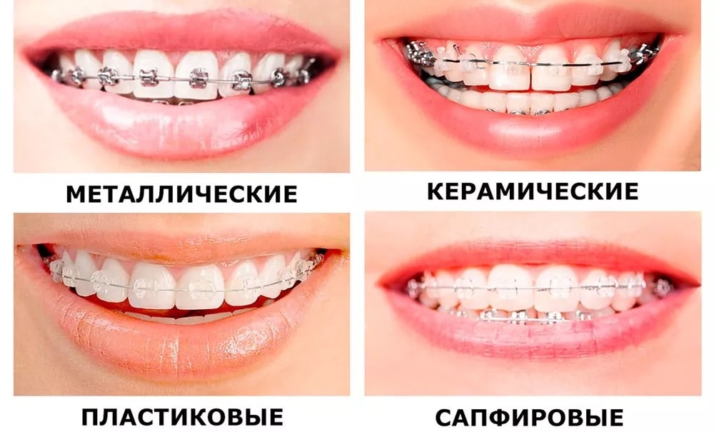 Установка самолигирующих (безлигатурных) брекетов, цена в стоматологии Смайлик в Приокском районе Нижнего Новгорода
