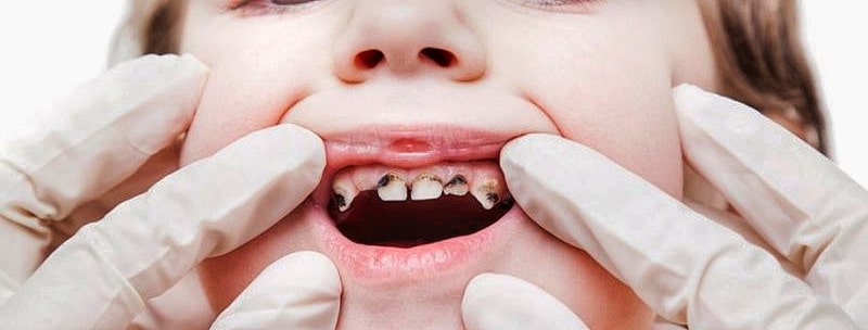 Лечение налета Пристли на молочных зубах у детей – стоматология Смайлик