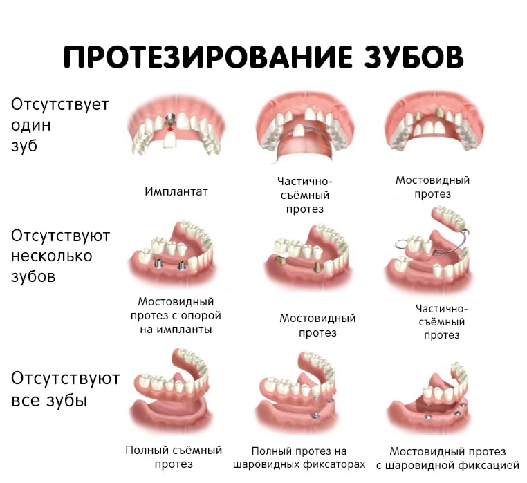 Протезирование зубов, виды протезов – Нижний Новгород, стоматология Смайлик